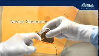 Implantable Defibrillator  06 The Implant Procedure [upl. by Jeremie]